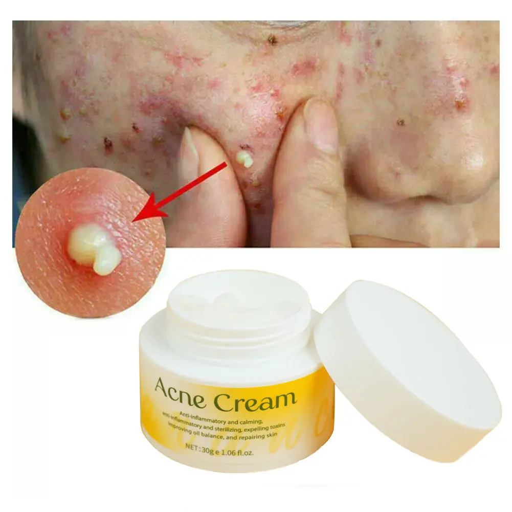 Acne Scar Spot Repair Facial Cream